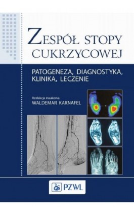 Zespół stopy cukrzycowej - Waldemar Karnafel - Ebook - 978-83-200-5399-9