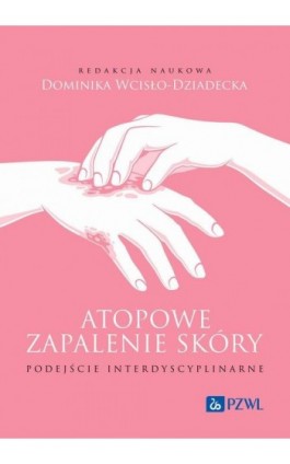 Atopowe zapalenie skóry Podejście interdyscyplinarne - Ebook - 978-83-01-24175-9