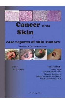 Cancer of the Skin - case reports of skin tumors - Piotr Brzezinski - Ebook - 978-83-931309-0-0