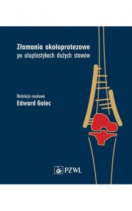 Złamania okołoprotezowe po aloplastykach dużych stawów - Ebook - 978-83-200-6368-4